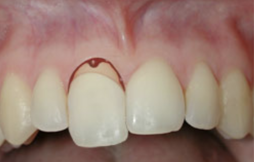 Tooth Extrusion