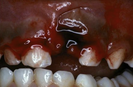 Tooth Avulsion