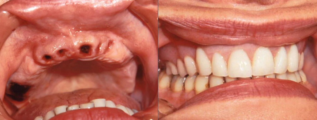 Patient with Immediate Dentures