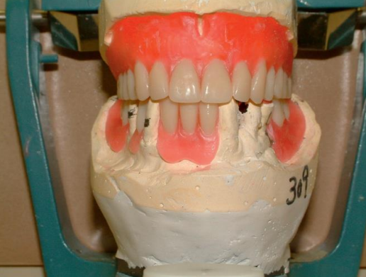 Stone Cast of Immediate Dentures