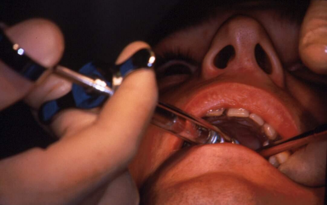 Extraction of Teeth