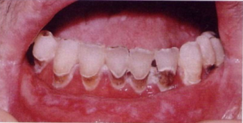 Patient with Xerostomia