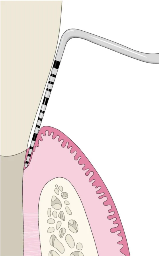 Periodontal Probing