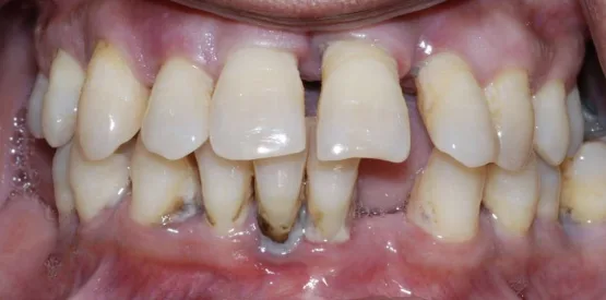 Periodontitis