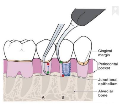 Dental Scaling and Root Planing