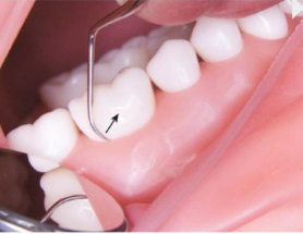 Dental Scaling