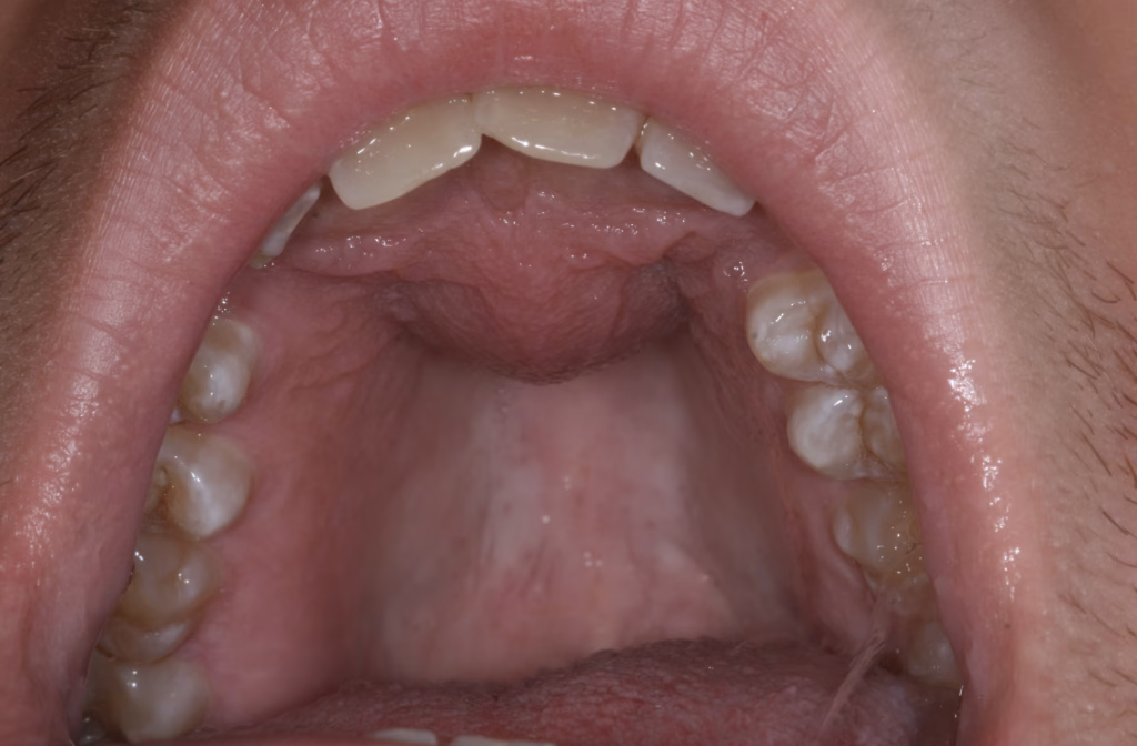 Nasopalatine Duct Cyst