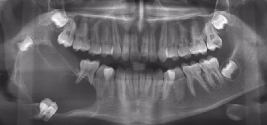 Unicystic Ameloblastoma