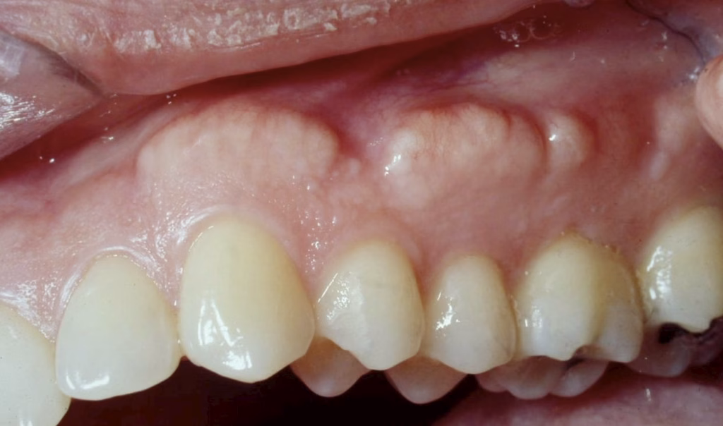 Osteoma Clinic Photo